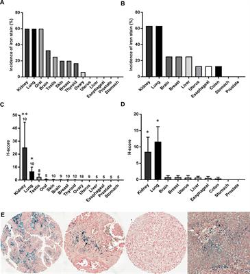 Iron accumulation typifies renal cell carcinoma tumorigenesis but abates with pathological progression, sarcomatoid dedifferentiation, and metastasis